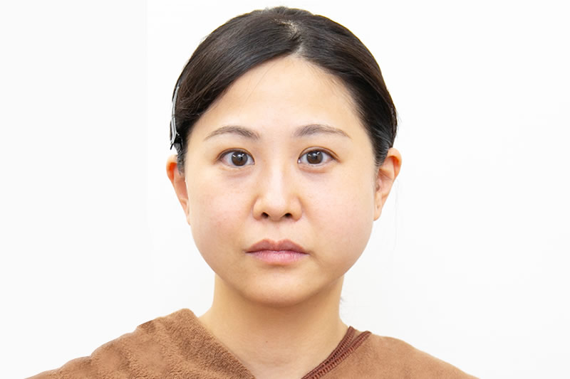 糸リフトの手術直後の症例