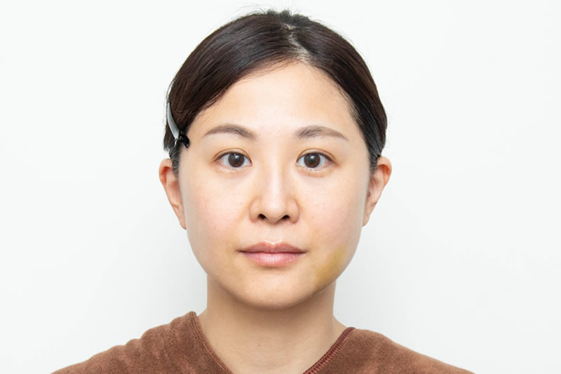 糸リフトの１週間後の症例