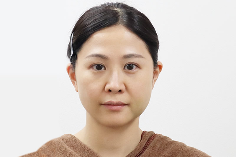 糸リフトの２日後の症例