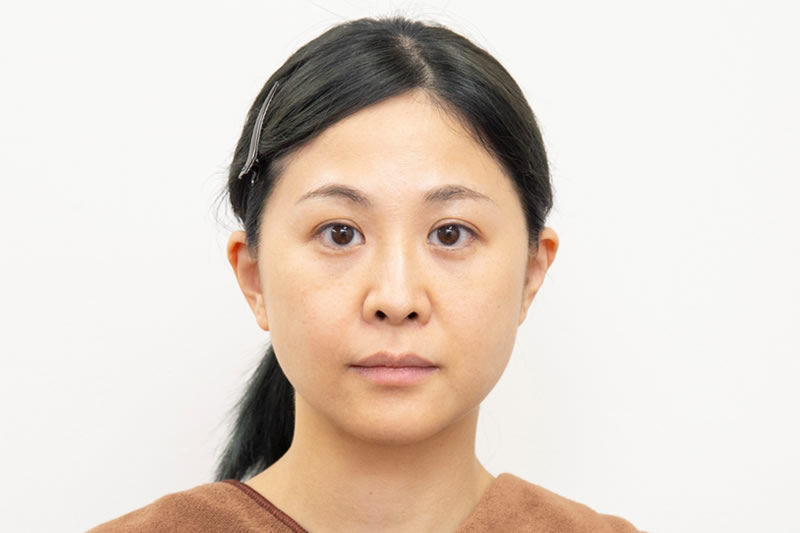 糸リフトの２週間後の症例