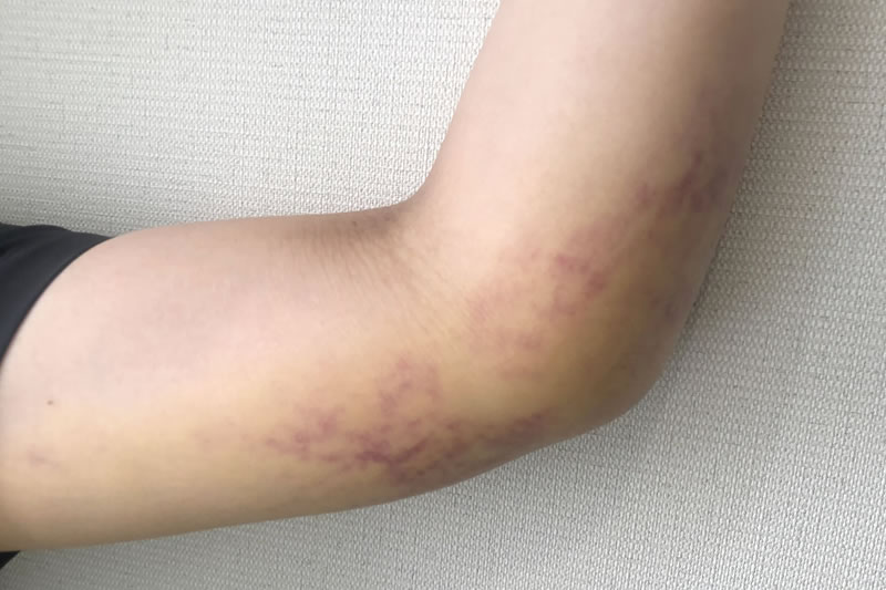 脂肪吸引後の二の腕の内出血