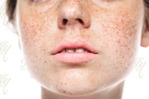 そばかすが顔中にある女性