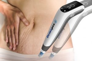 ダーマペンの妊娠線治療のイメージ