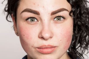ニキビに悩む女性