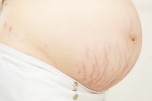 妊娠線ができている妊婦のお腹