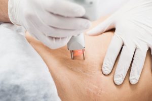 妊娠線にレーザーを当てているところ