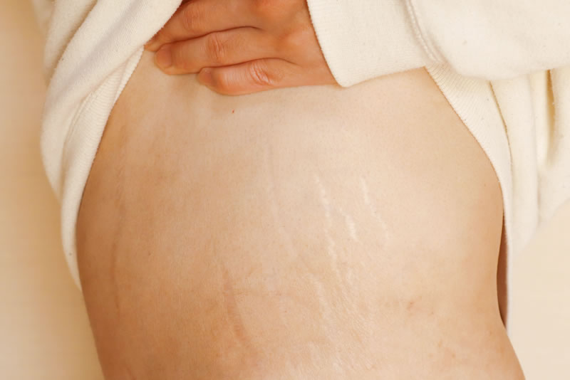 妊娠線を見せている女性
