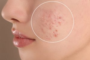 頬のニキビのイメージ