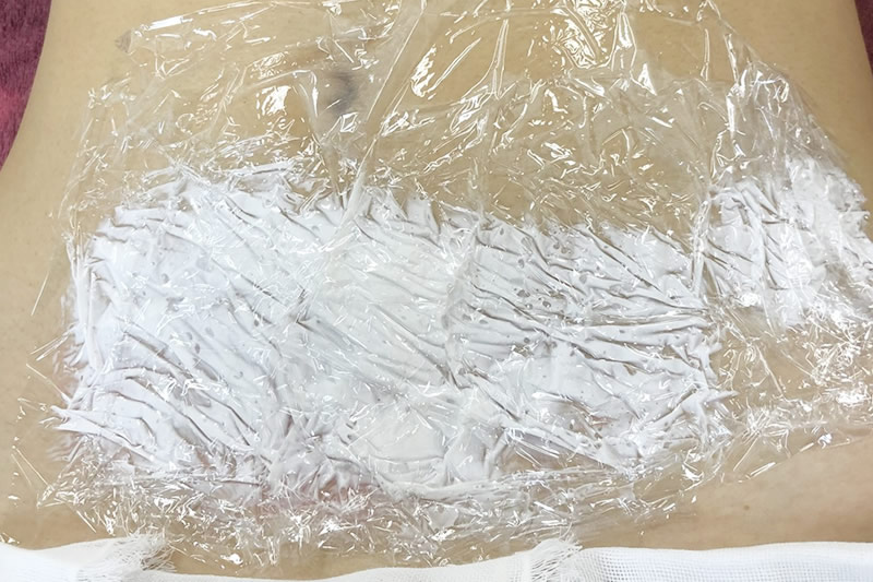 麻酔クリームを妊娠線に塗っているところ