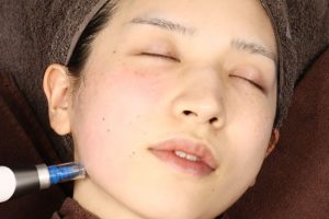 ダーマペン４を頬に当てているところ