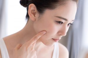 ニキビに悩む女性