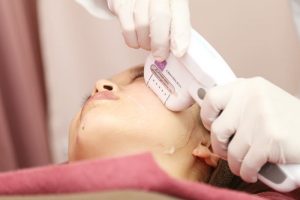 ハイフを受けているところ