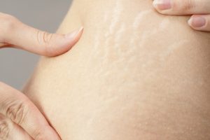 妊娠線を強調する女性