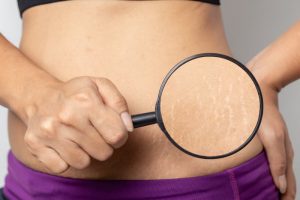 妊娠線を虫眼鏡で強調する女性