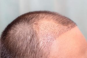 植毛をしている頭