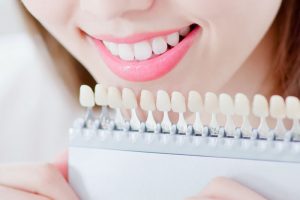 ホワイトニングで歯が白くなった女性1