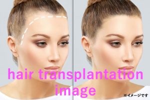 女性の自毛植毛