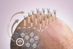 植毛のイメージ