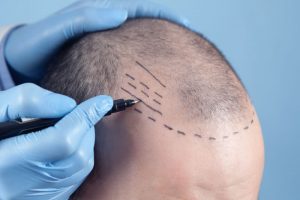 植毛のデザイン