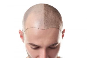 自毛植毛のビフォアーアフター