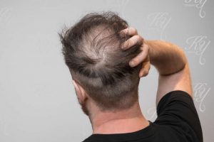 薄毛で悩む男性