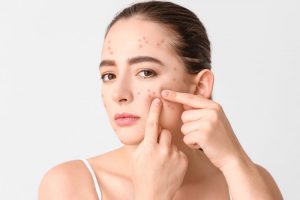 ニキビに悩む大人の女性