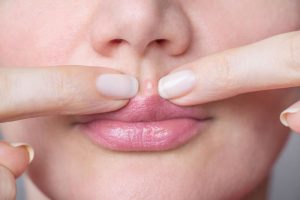 口元にニキビのある女性の顔