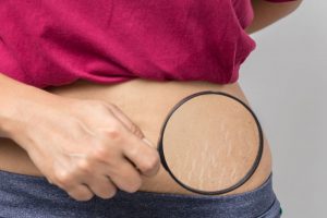 妊娠線に悩む女性