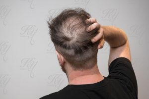 薄毛で悩んでいる男性