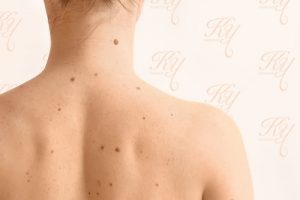 ほくろが多く悩んでいる女性