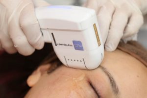 ハイフを目回りに照射しているところ