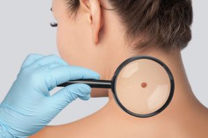 大きいほくろが気になる女性