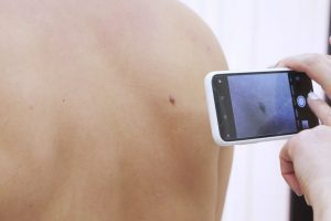 急にできたほくろの経過撮影をしているところ