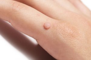 手のいぼが気になる女性