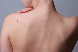 背中にほくろがある女性