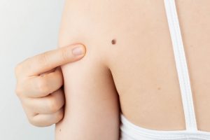 背中の黒子が気になっている女性