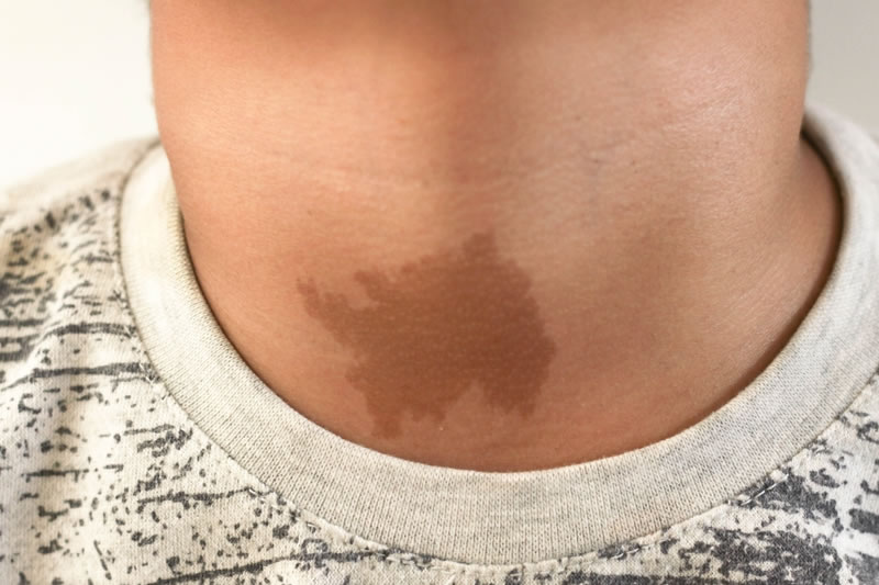 茶あざのある男性