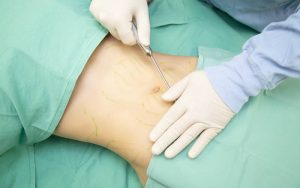 お腹の脂肪吸引