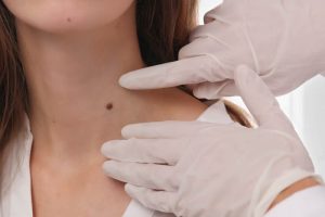 ほくろが気になる女性