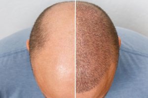 自毛植毛を行った男性