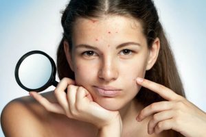 ニキビが気になる女性
