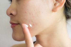 ニキビに悩む女性