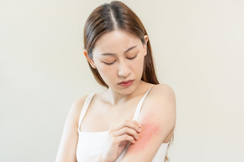 肌に赤みやかゆみが出ている状態を気にしている女性
