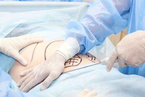 脂肪吸引の手術をしている様子