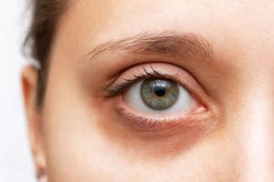 目の下のクマを気にしている女性