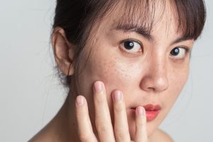 シミに悩む女性