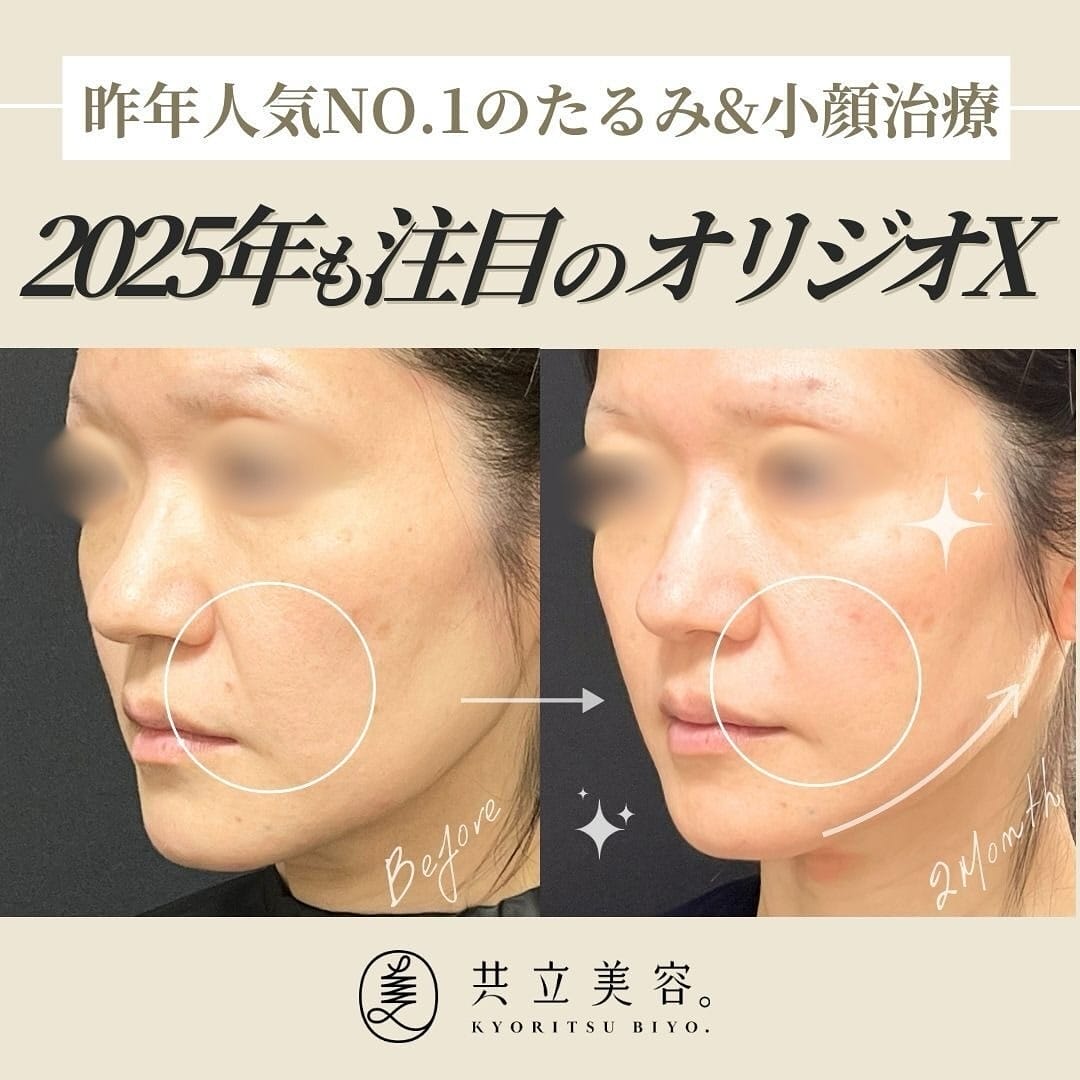 【医師監修】オリジオXとは?最新リフトアップ治療