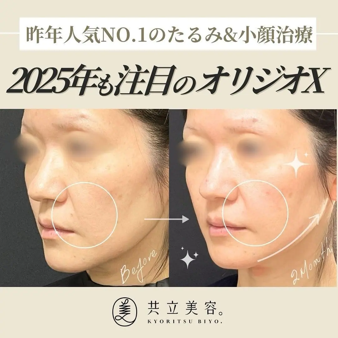 【医師監修】オリジオXとは?最新リフトアップ治療
