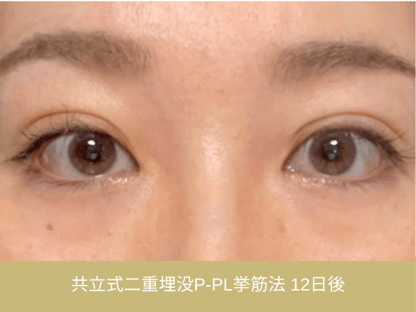 共立式二重埋没P-PL挙筋法の術後経過|施術12日後の目元