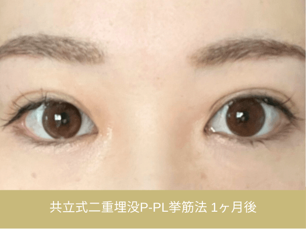 共立式二重埋没P-PL挙筋法の術後経過|施術1か月後の目元